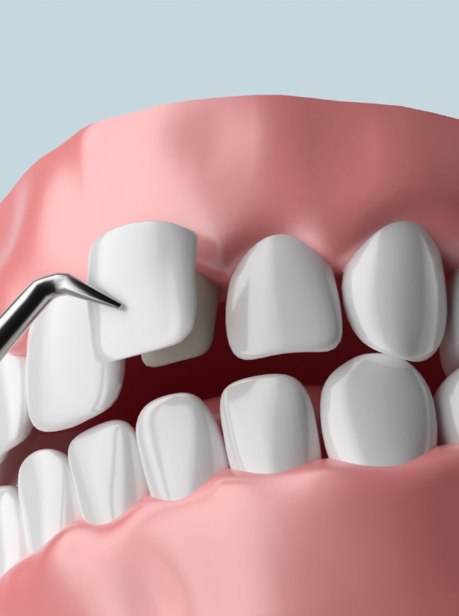 Treatment - Shine Dental