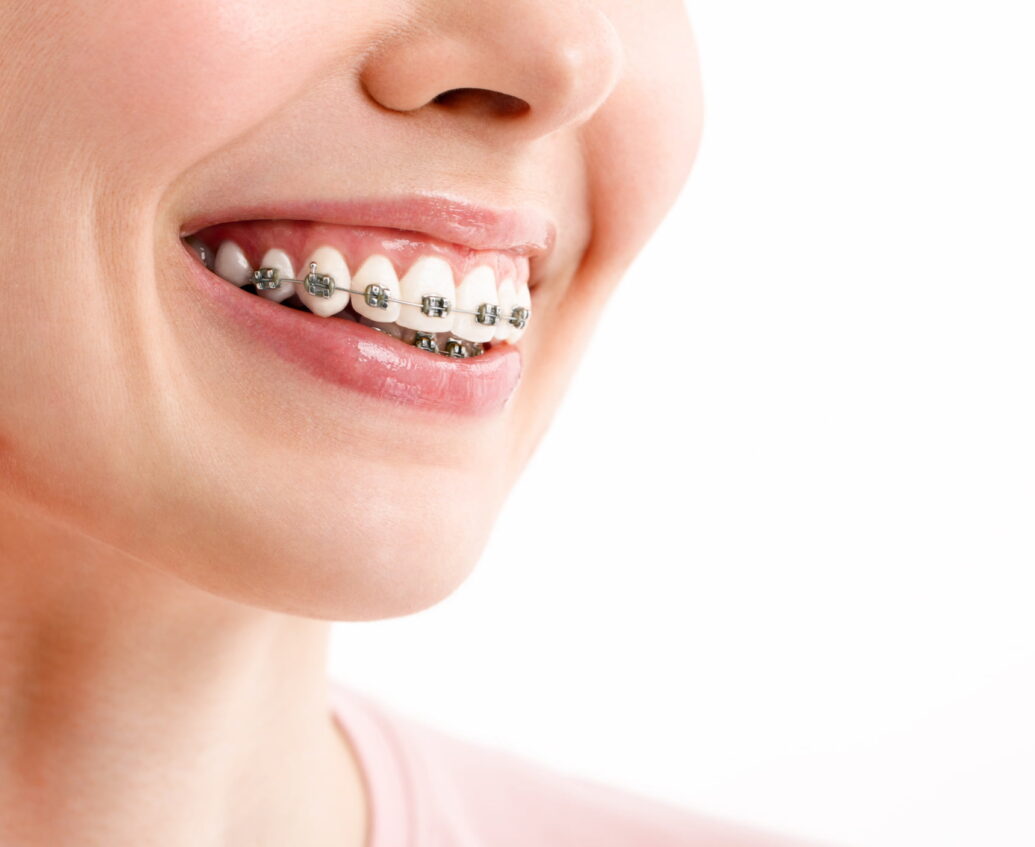 Seven Fun Facts About Invisalign - Long Grove Dental Long Grove