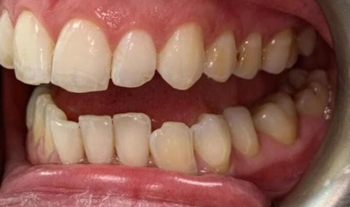 Before - Shine Dental