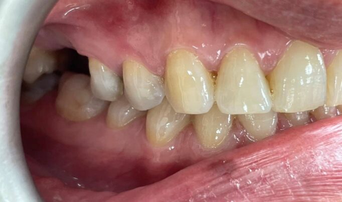 Before - Shine Dental